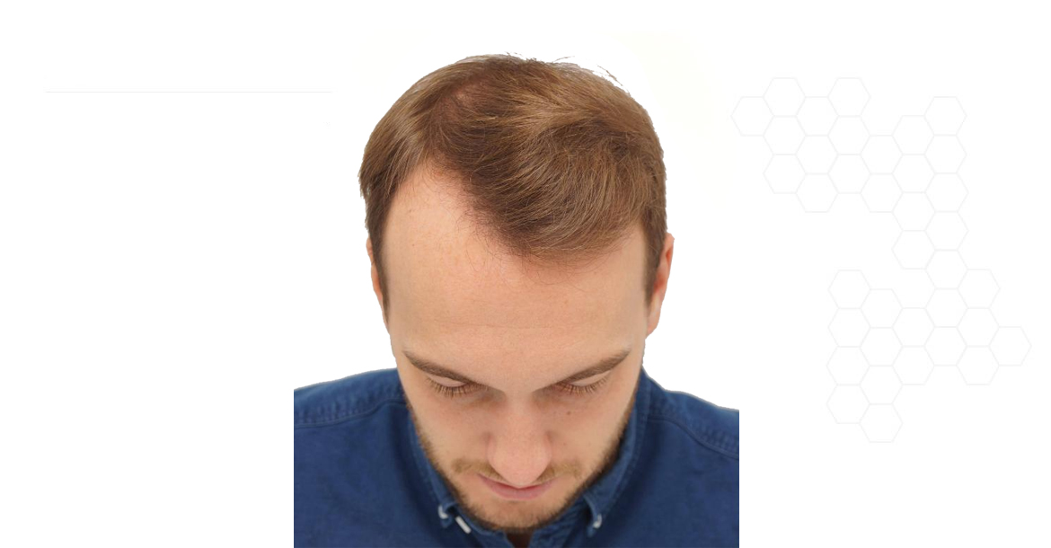 After-1500 Graft