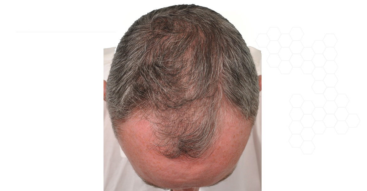 Before-4000 Greft